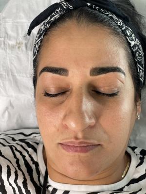 restructuration sourcils